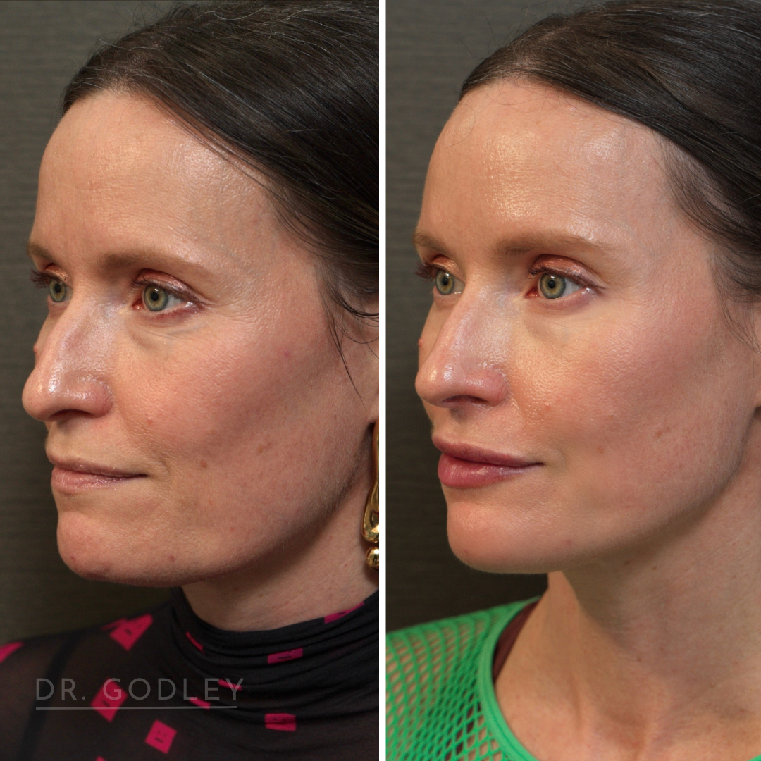 before and after botox and radiesse