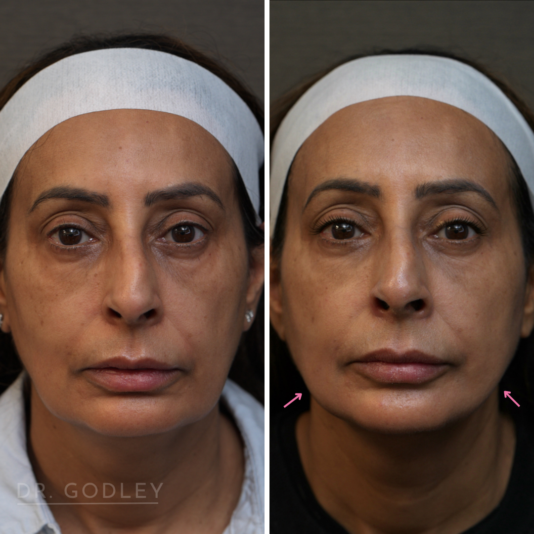 before and after thread lift
