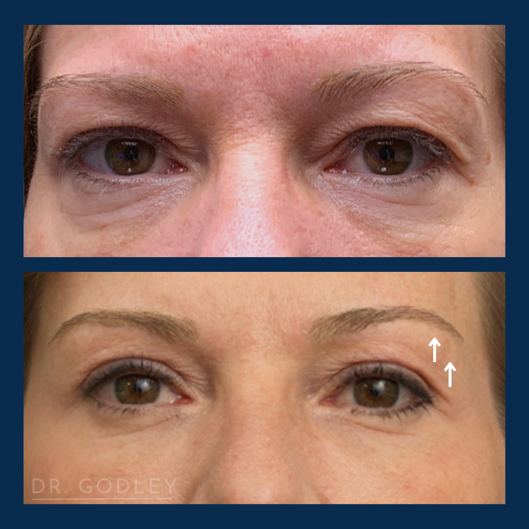 Plex R Results Plexr Plus Vancouver B.C. — Godley Clinic