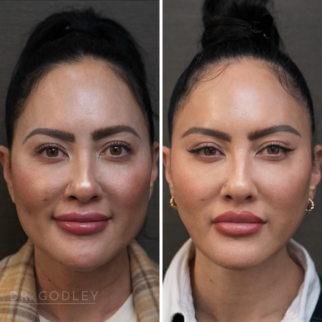 Radiesse before and after