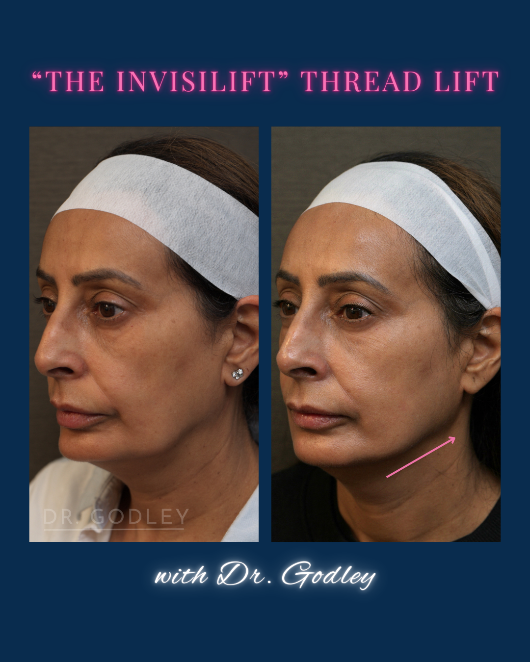 Invislift thread lift before and after
