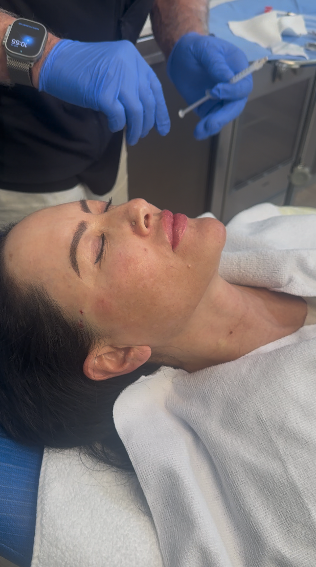 Sculptra Vancouver