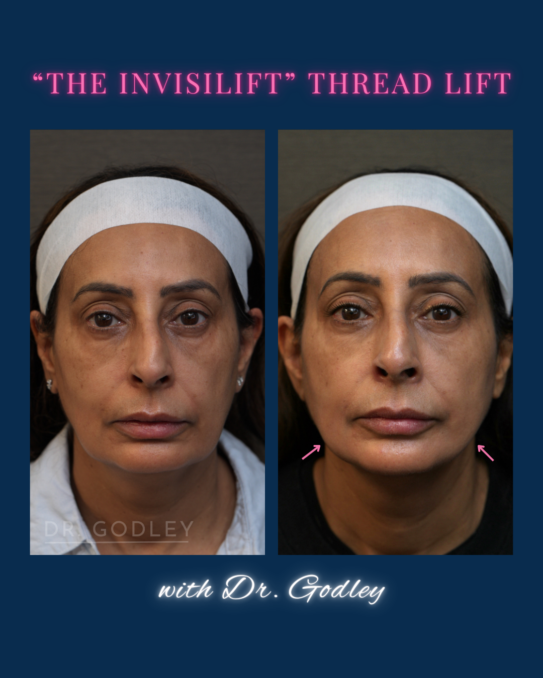 Invislift thread lift before and after