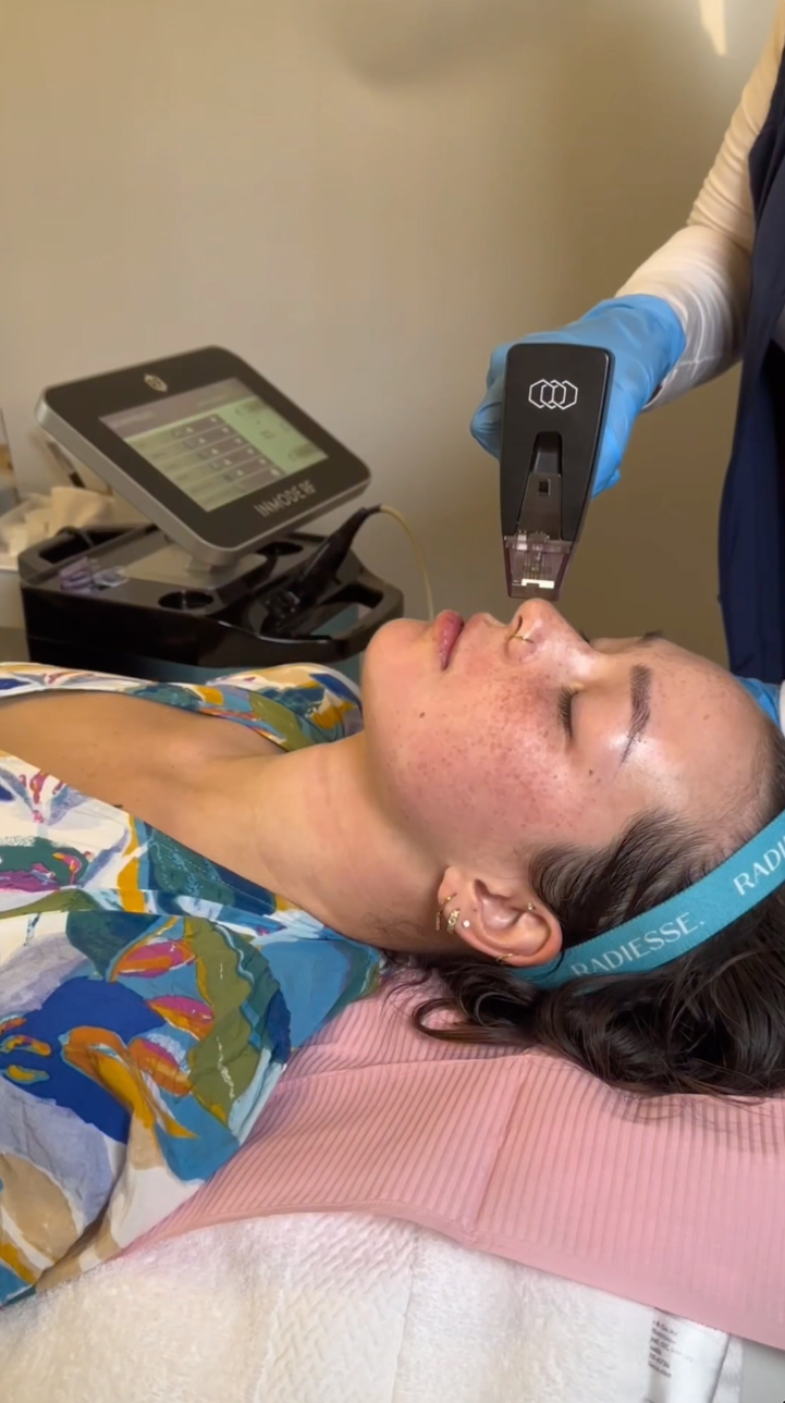 RF Microneedling