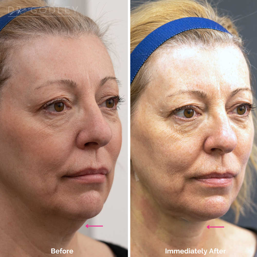 Thread Lift Vancouver — Godley Clinic