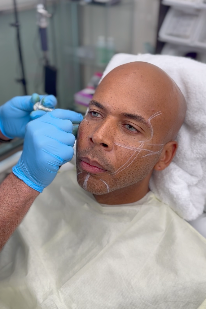 Radiesse Vancouver Patient