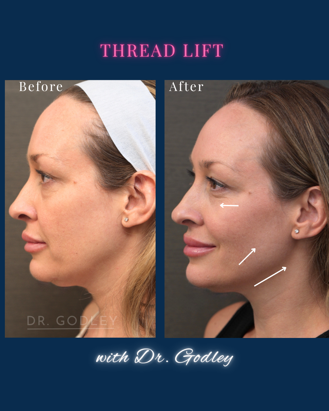 before and after thread lift