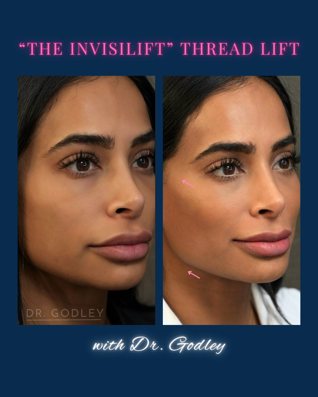 Invislift thread lift before and after