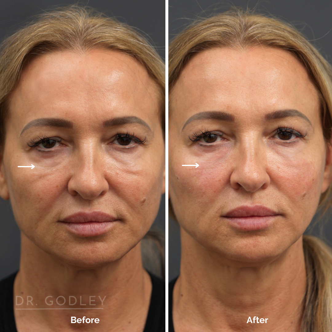 before and after under eye thread lift