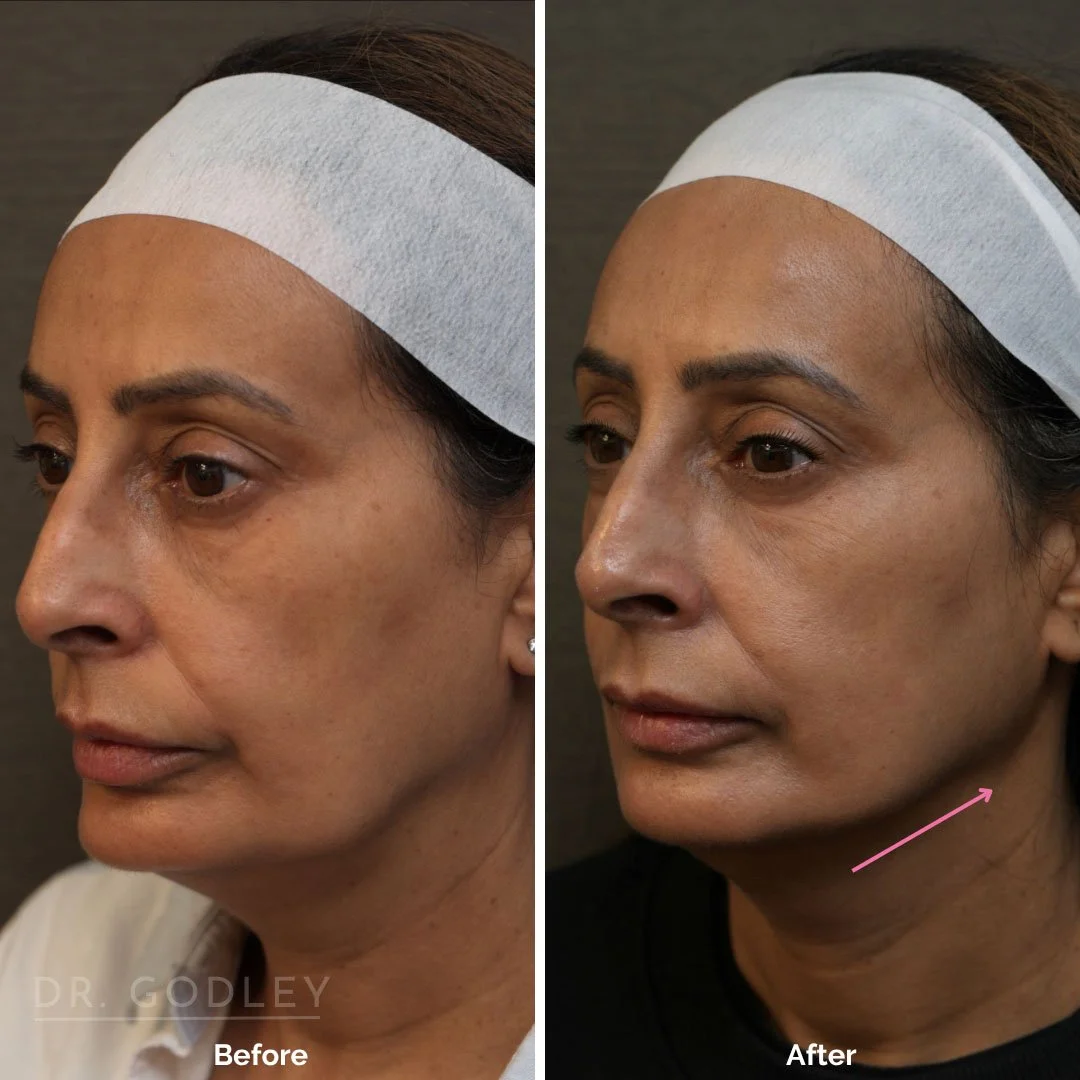 Radiesse as part of a treatment plan.