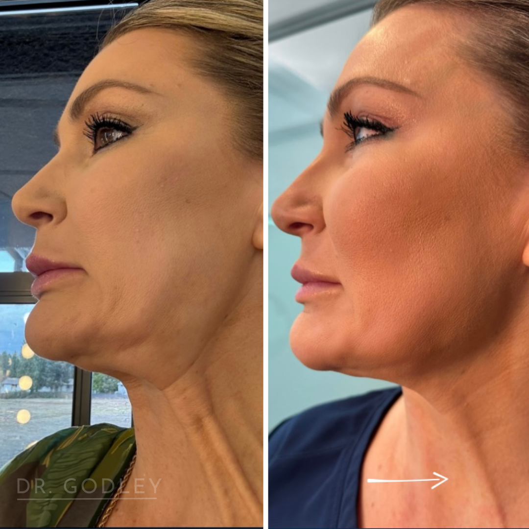 Nefertiti neck lift with botox
