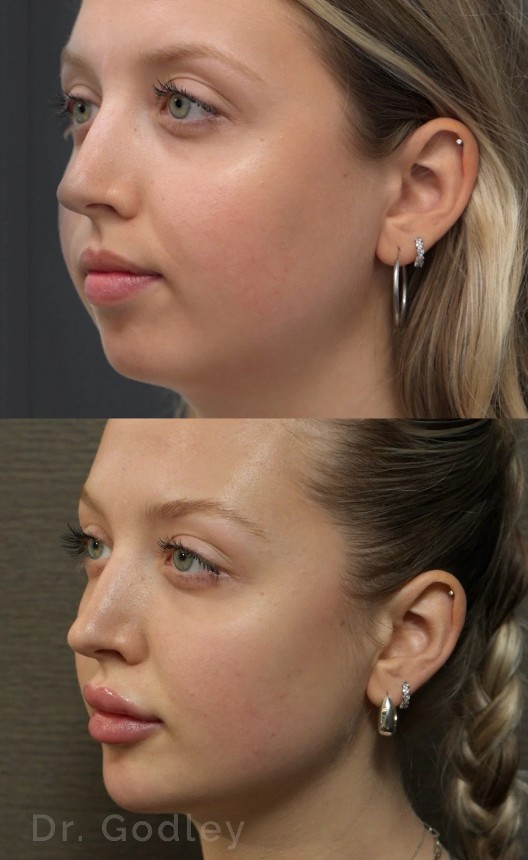 lip filler before and after dr. godley