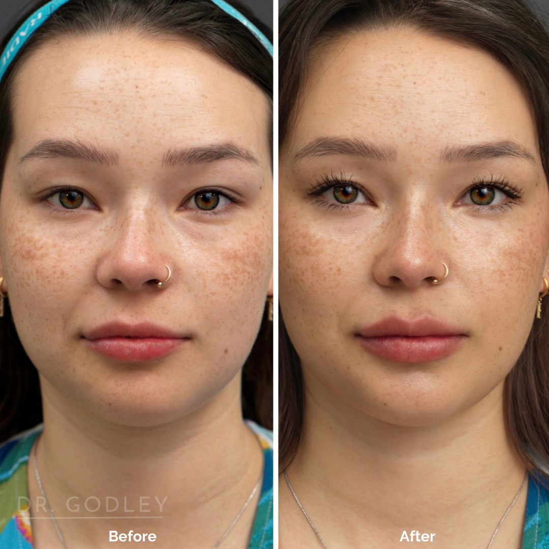 lip filler before and after