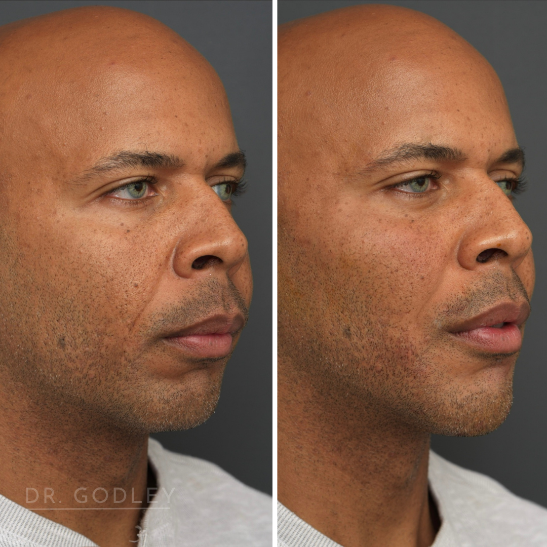 Radiesse as part of a treatment plan.