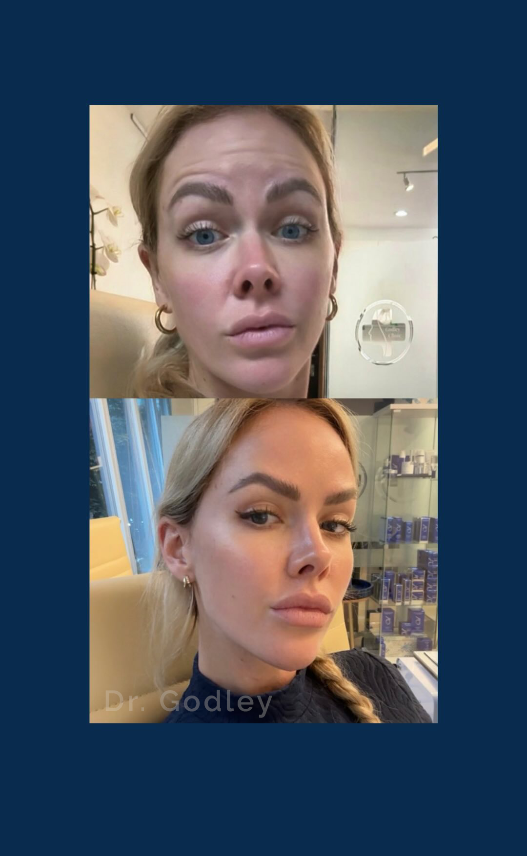 Botox Results Timeline: Understanding What Happens After Treatment
