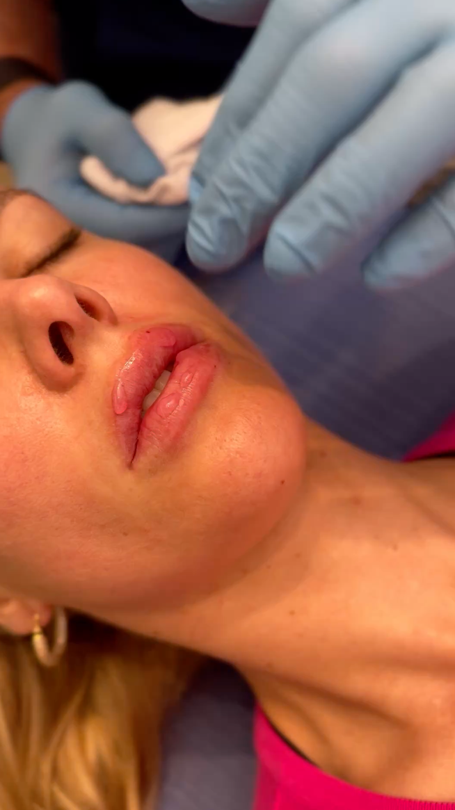 lip filler vancouver