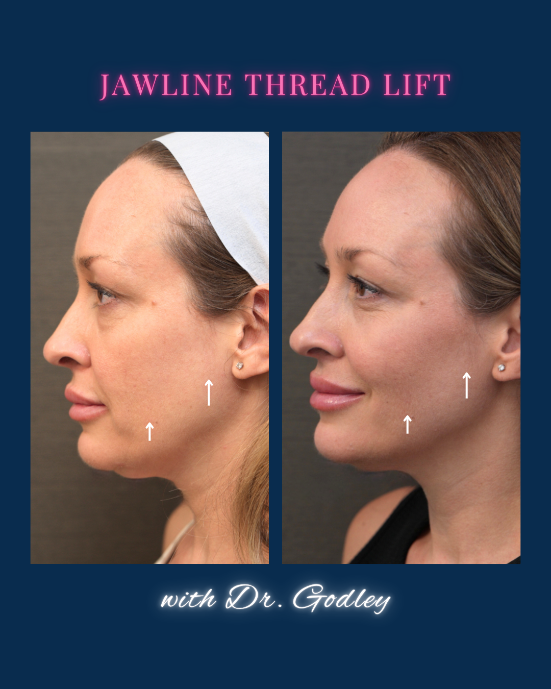 Jawline Thread Lift