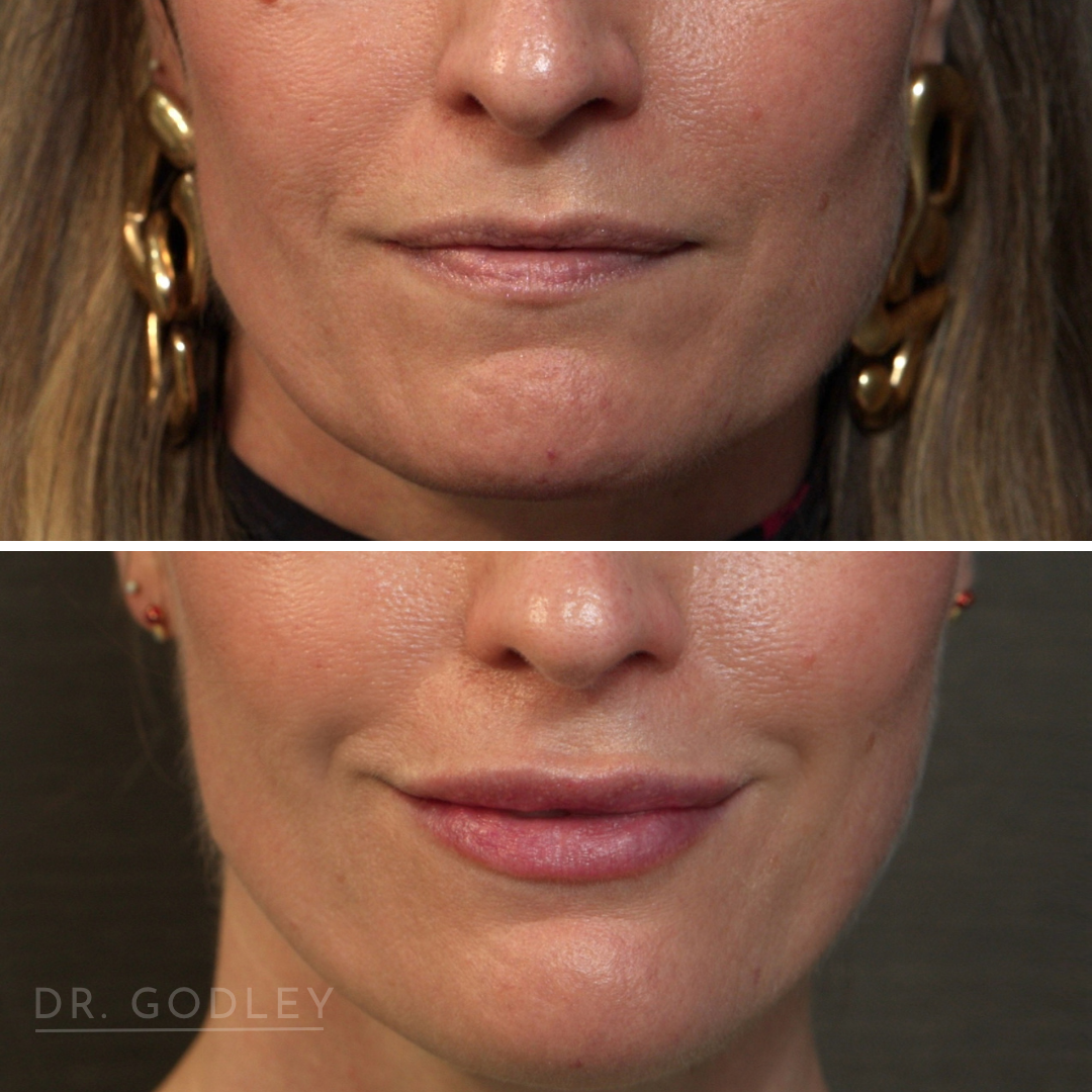 subtle lip filler lip augmentation bc
