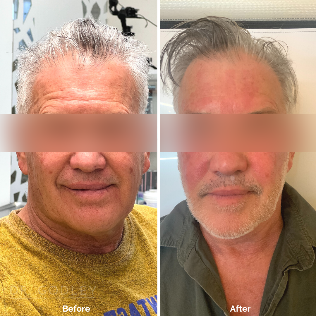 Morpheus8 before and after