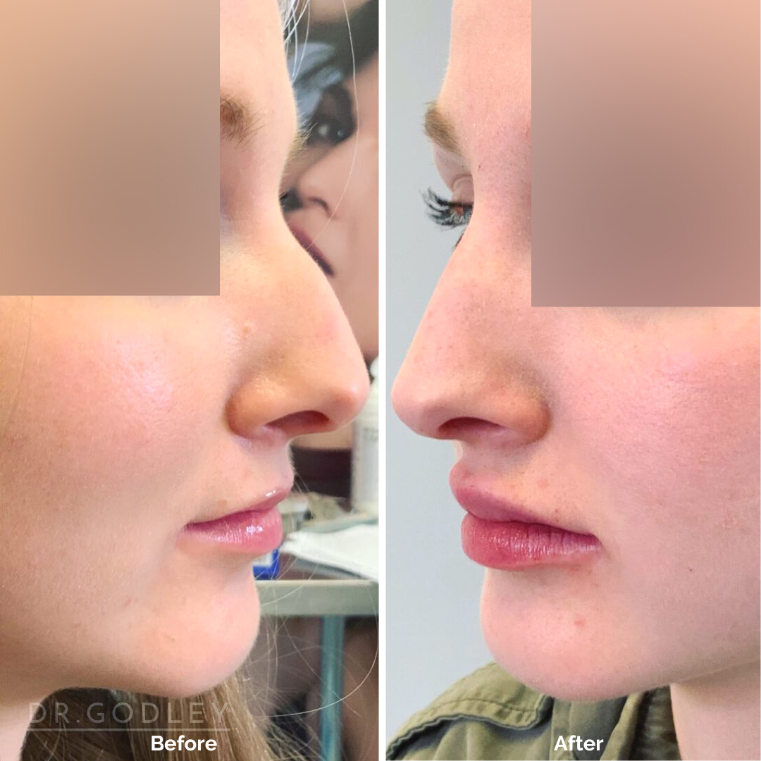 Non Surgical Nose Job Godley Clinic non-surgical-nose-job-godley-clinic