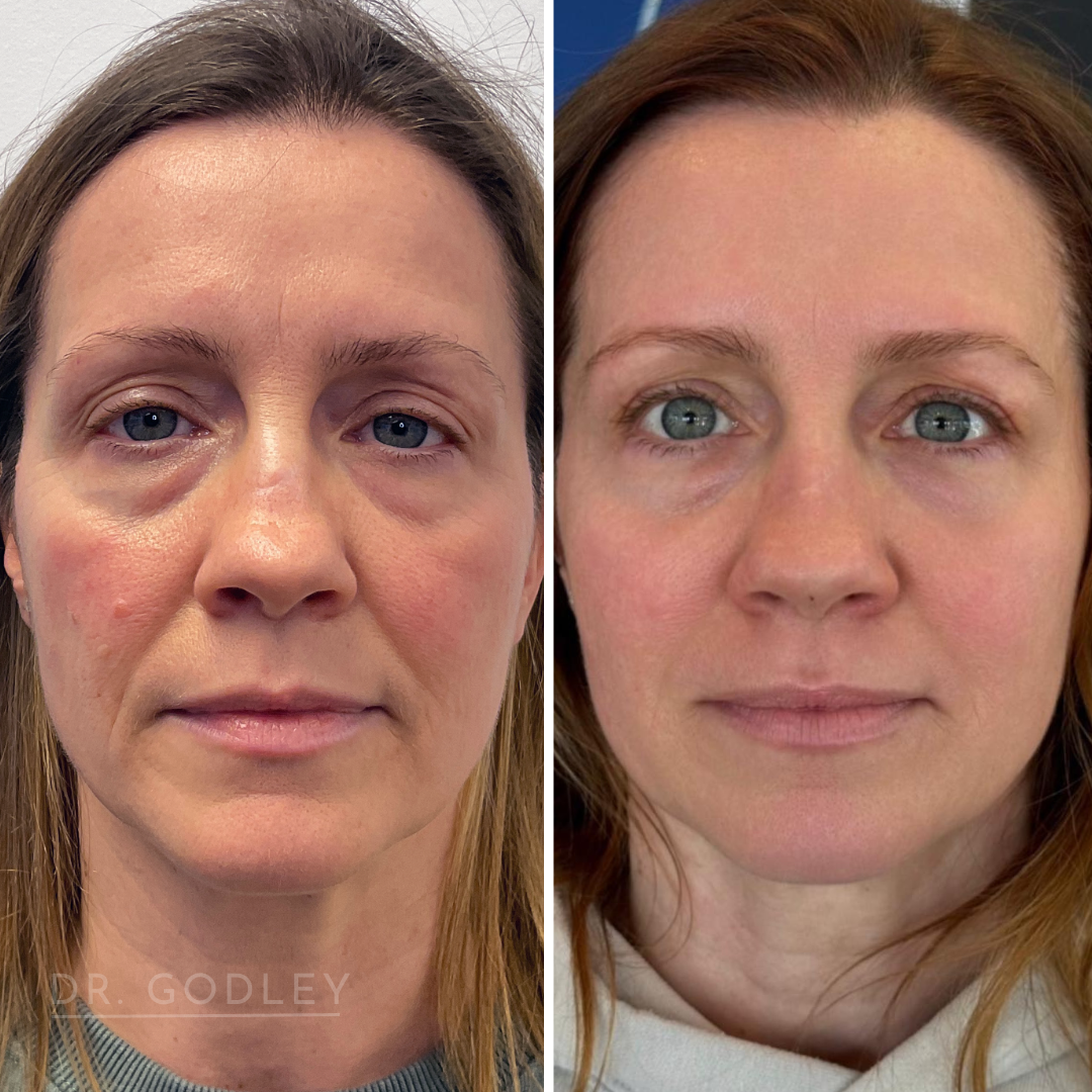 Radiesse as part of a treatment plan.