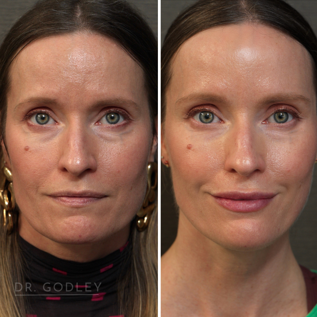 botox before and after abbotsford