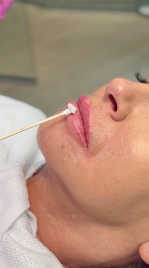 How Long Does Lip Filler Last and What Makes It Fade Faster