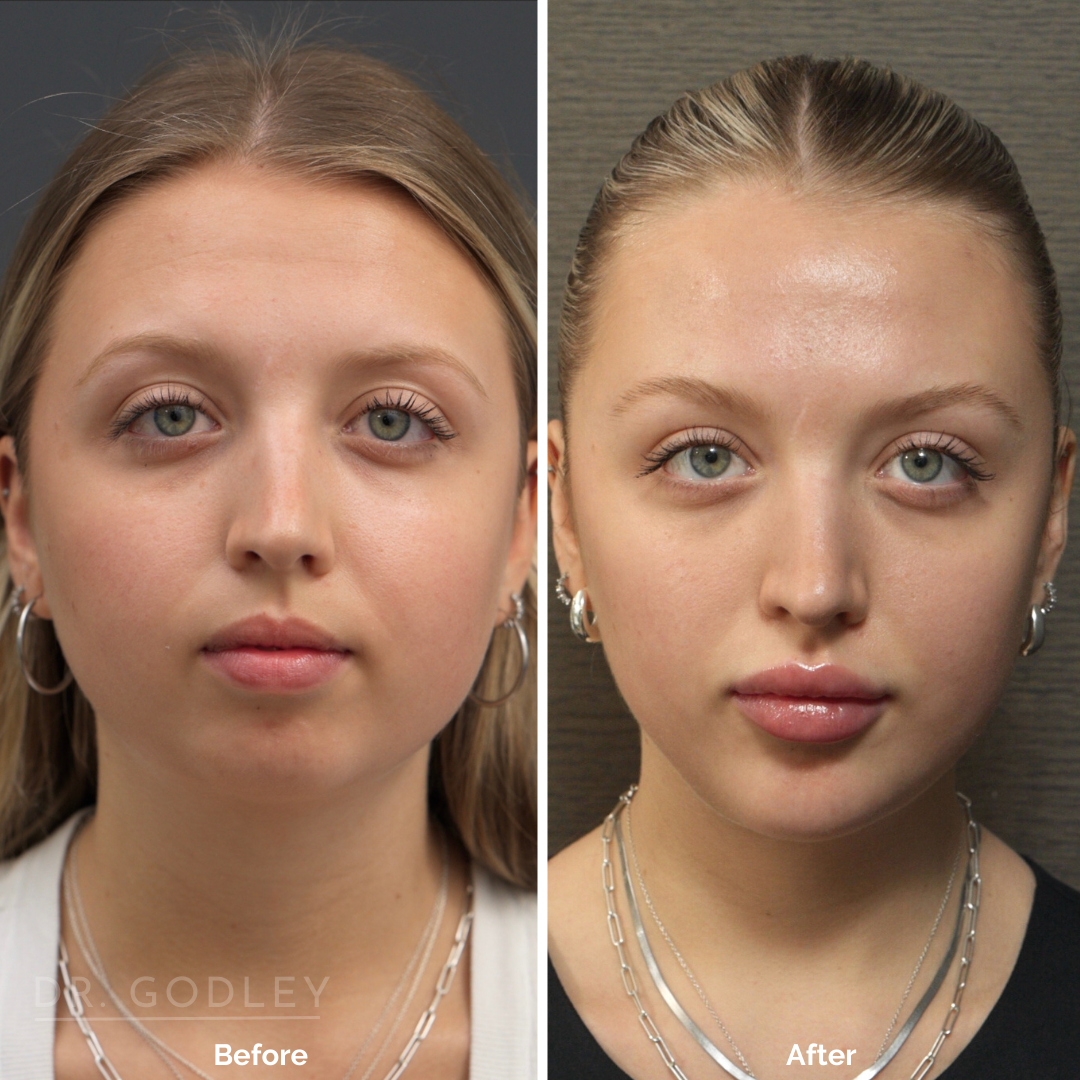 chin filler before and after