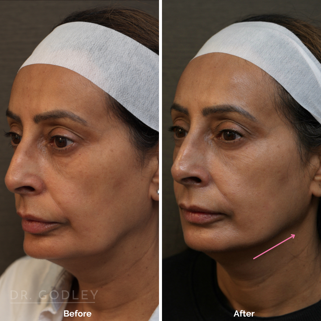 before and after thread lift