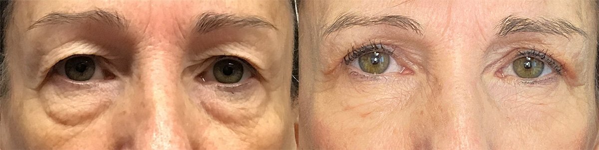 Under Eye Bags Treatments  Eye Rejuvenation Macon & Madison, GA