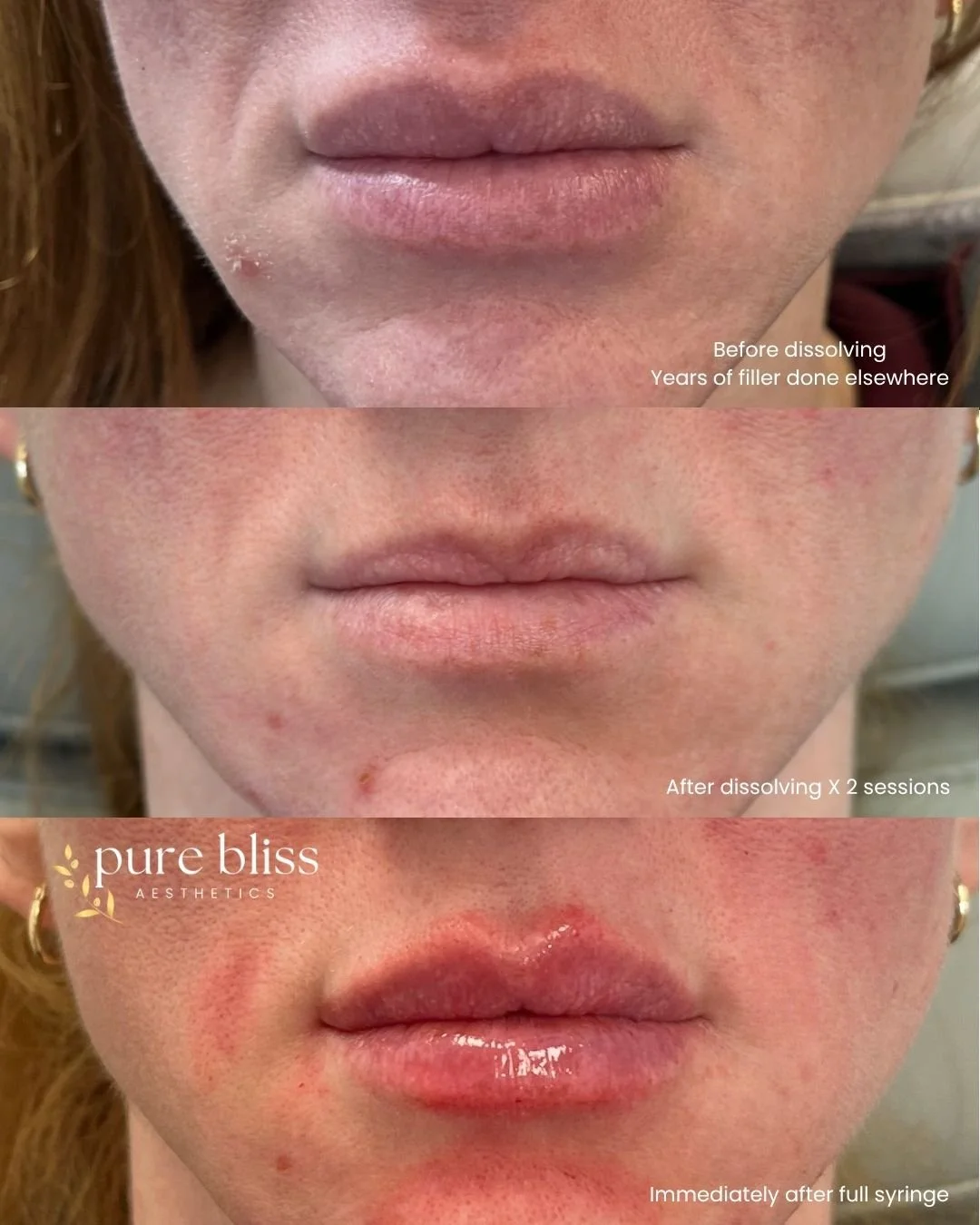 Lip filler before and after. Before dissolving, after dissolving, and after 1ml of Restylane Kysse.
