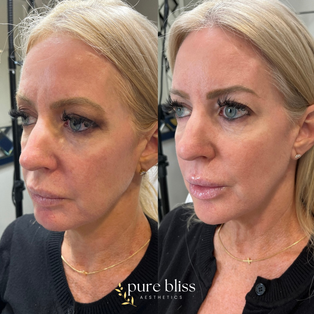 8 point lift before and after using dermal filler. Here we strategically placed 2ml of filler in the cheeks, chin, jawline, and nasolabial folds.
