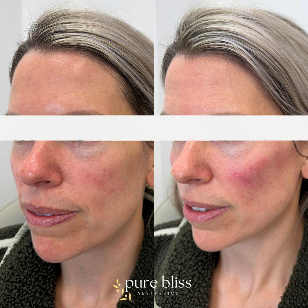 cheek-filler-worcester-medspa-01.png