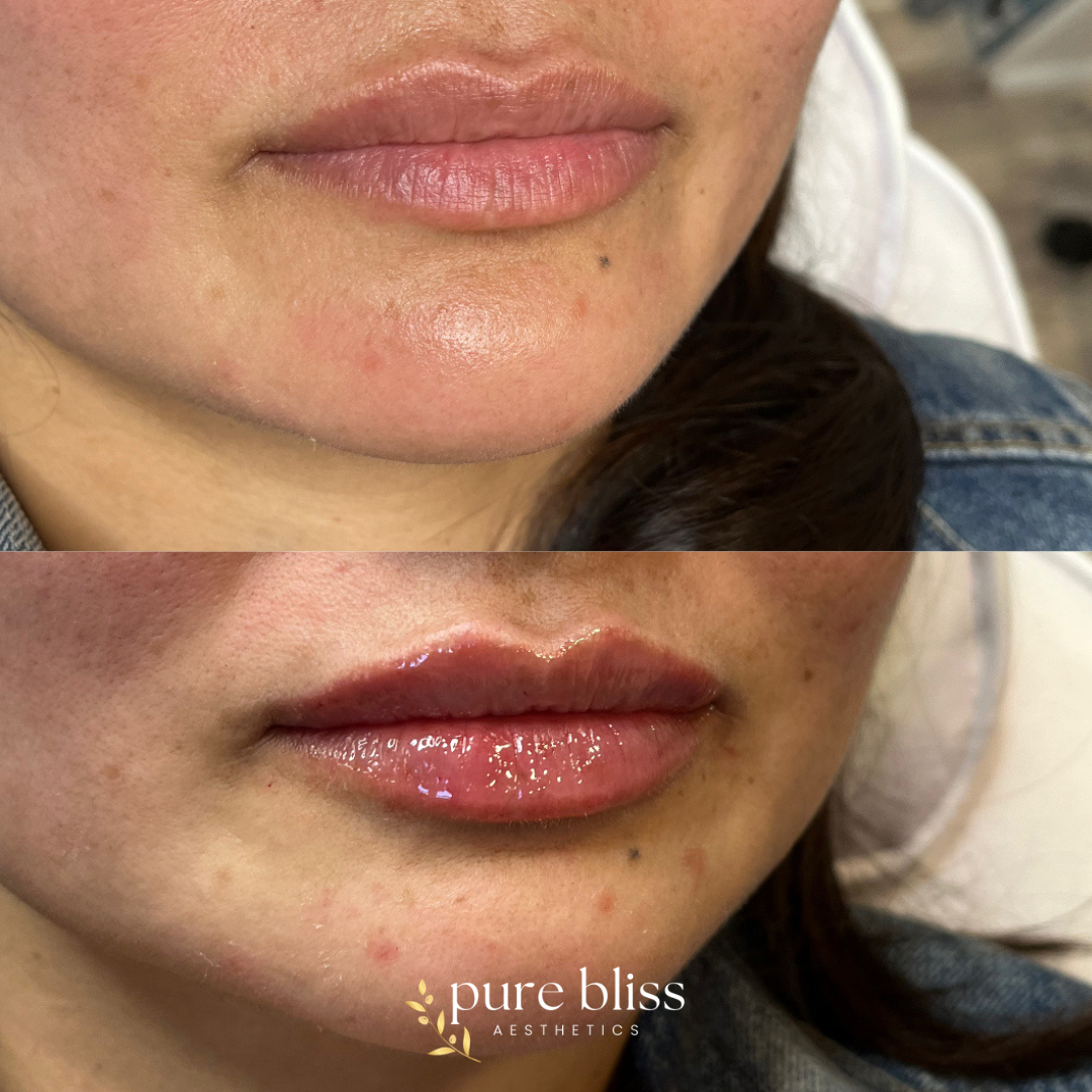 Lip filler before and after with 0.5ml of Restylane Kysse 