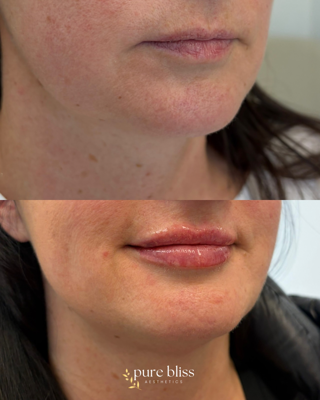 Lip filler before and after using 1.2ml Revanesse Versa.