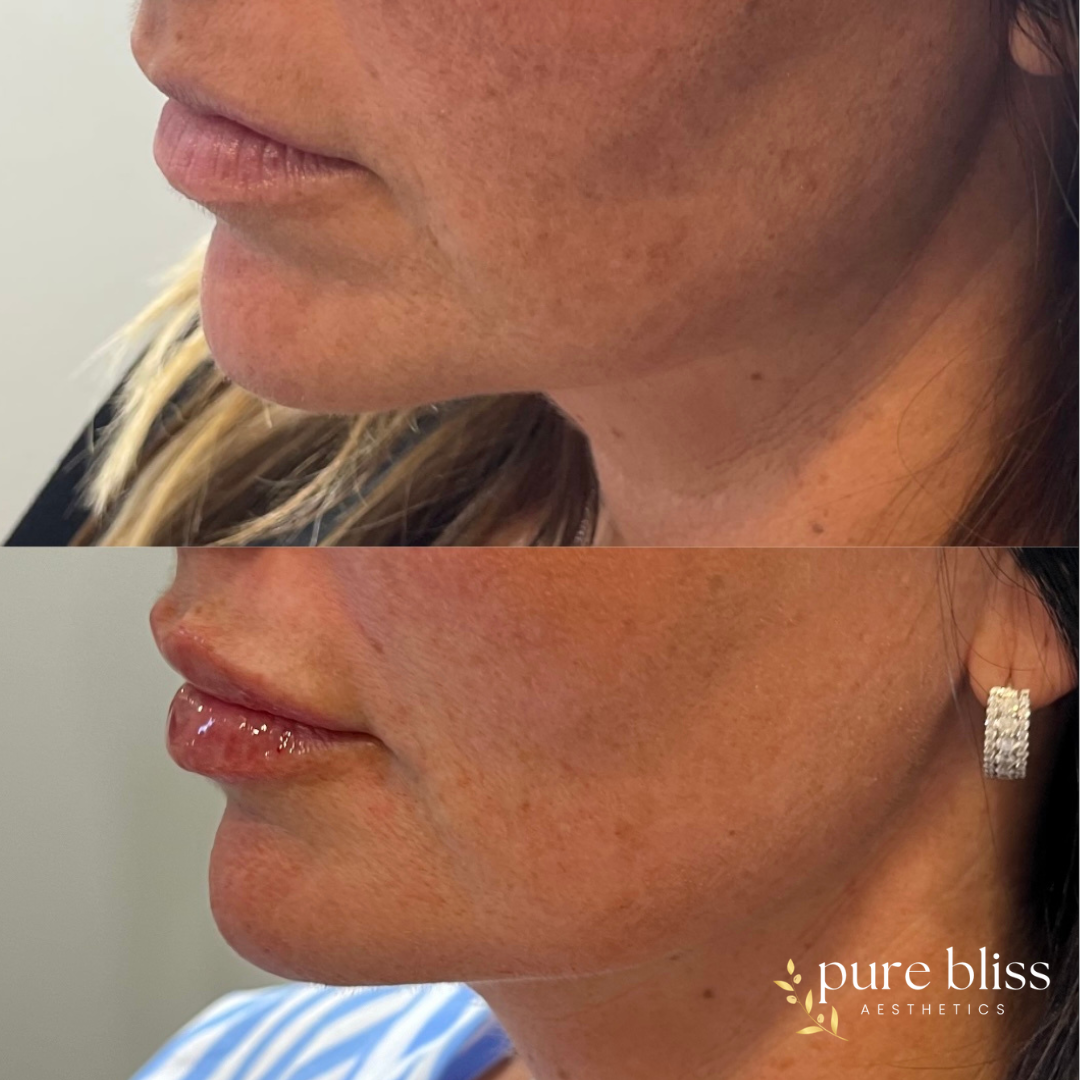 Filler before and after with 0.8ml of Revanesse Versa in the pre-jowl area and marionette lines to help with jowls. 0.4ml remainder placed in lips.