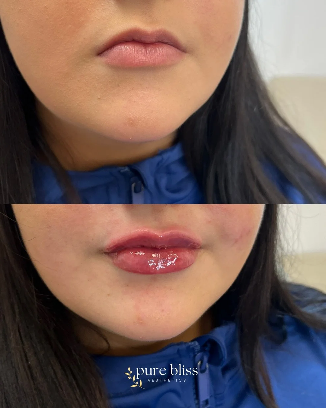 ✨ Lip filler doesn&rsquo;t have to be overly full, dramatic, or exaggerated.

When placed softly and naturally, in harmony with your facial features, lip filler can create subtle volume, restore balance, and enhance your beauty in the most effortless