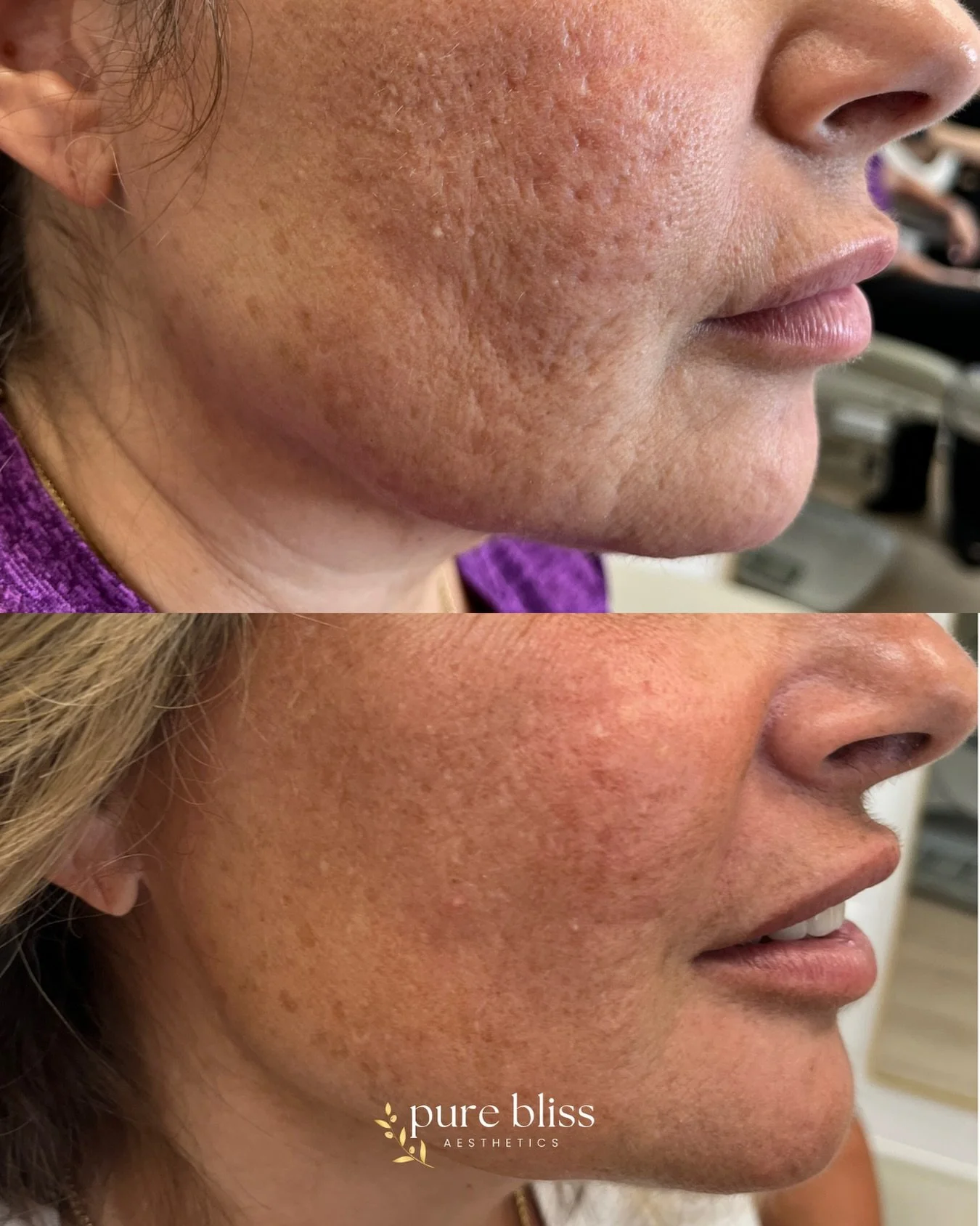 ✨ The power of Sylfirm-X in just 2 treatments! ✨
Tighter, smoother, glowing skin &mdash; with improved acne scars, softened fine lines, and firmer texture&hellip; all with zero downtime. 💫

Ready to experience these results for yourself? 

#SylfirmX