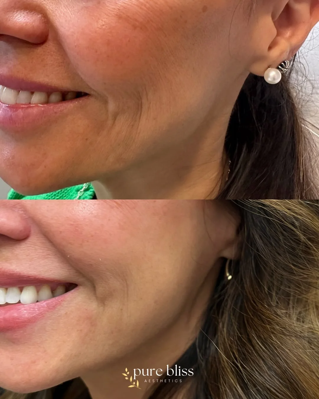 ✨ The power of Sculptra ✨

Sculptra isn&rsquo;t your average filler &mdash; it&rsquo;s a collagen stimulator designed to restore your skin&rsquo;s structure and youthful volume from within. 💉 

Unlike hyaluronic acid fillers that give instant result