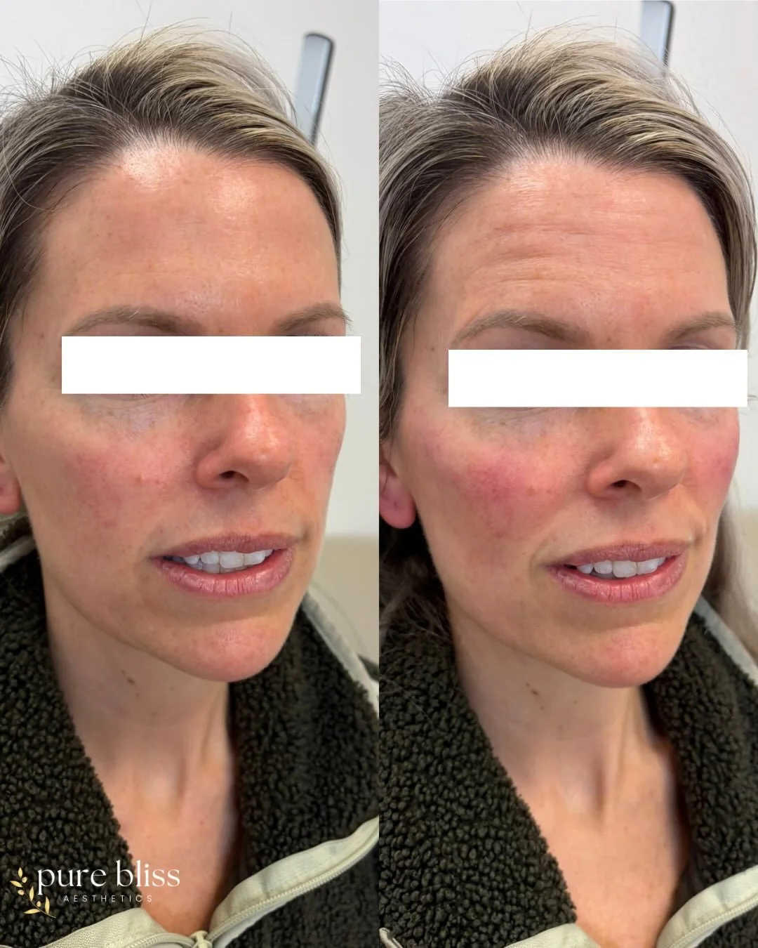 Cheek filler, but make it undetectable ✨

Subtle volume.
Soft contour.
A naturally lifted, well-rested look&mdash;like you just got the best sleep of your life 💫

No harsh lines, no overfilling&hellip; just enhancing her natural beauty in the most e