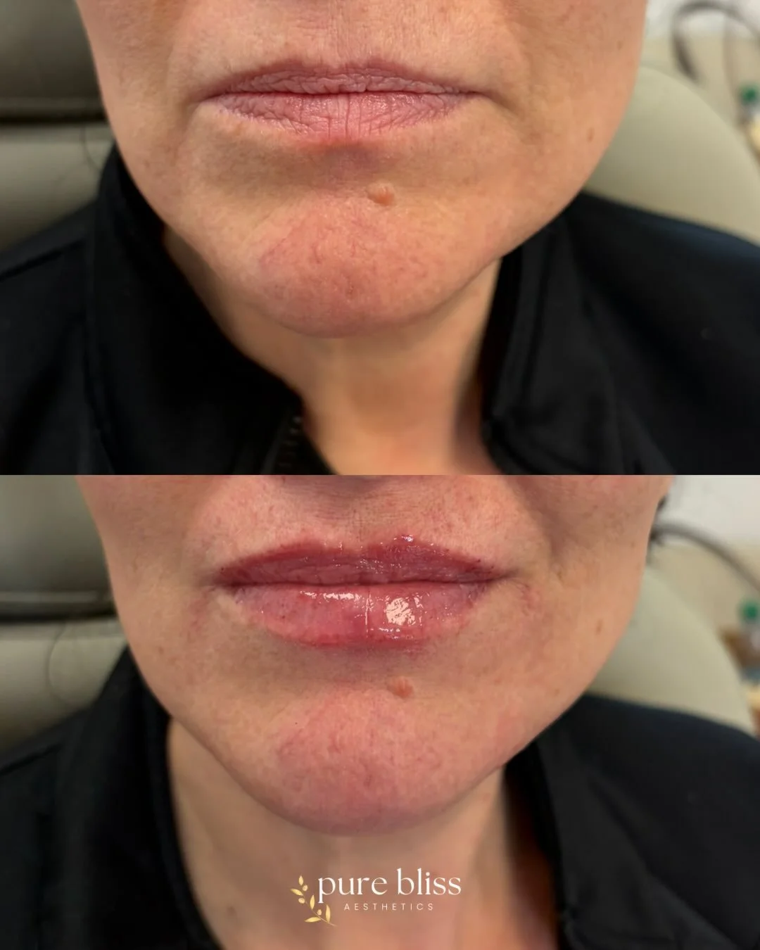 Lip filler isn&rsquo;t about changing your lips&mdash;it&rsquo;s about enhancing what&rsquo;s already there. Think hydration, softness, and that naturally plump, healthy look that still feels like you, just refreshed and glowing ✨