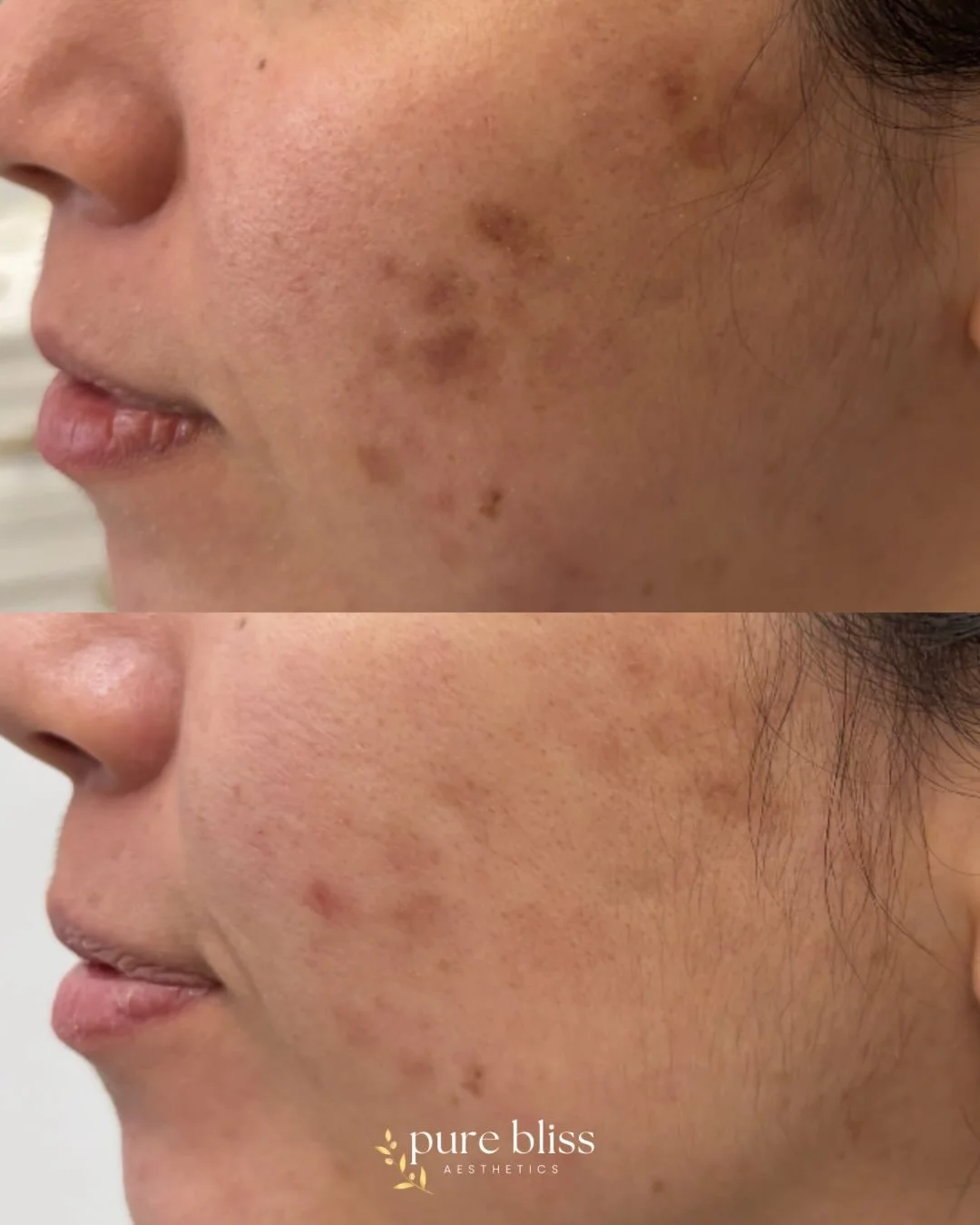 One session. Real results. ✨

Brighter. Healthier. More even.
Skin that looks refreshed&mdash;not overdone.

Microneedling works by stimulating your body&rsquo;s own collagen, so you glow naturally from within 🤍

This is just the beginning&hellip; i
