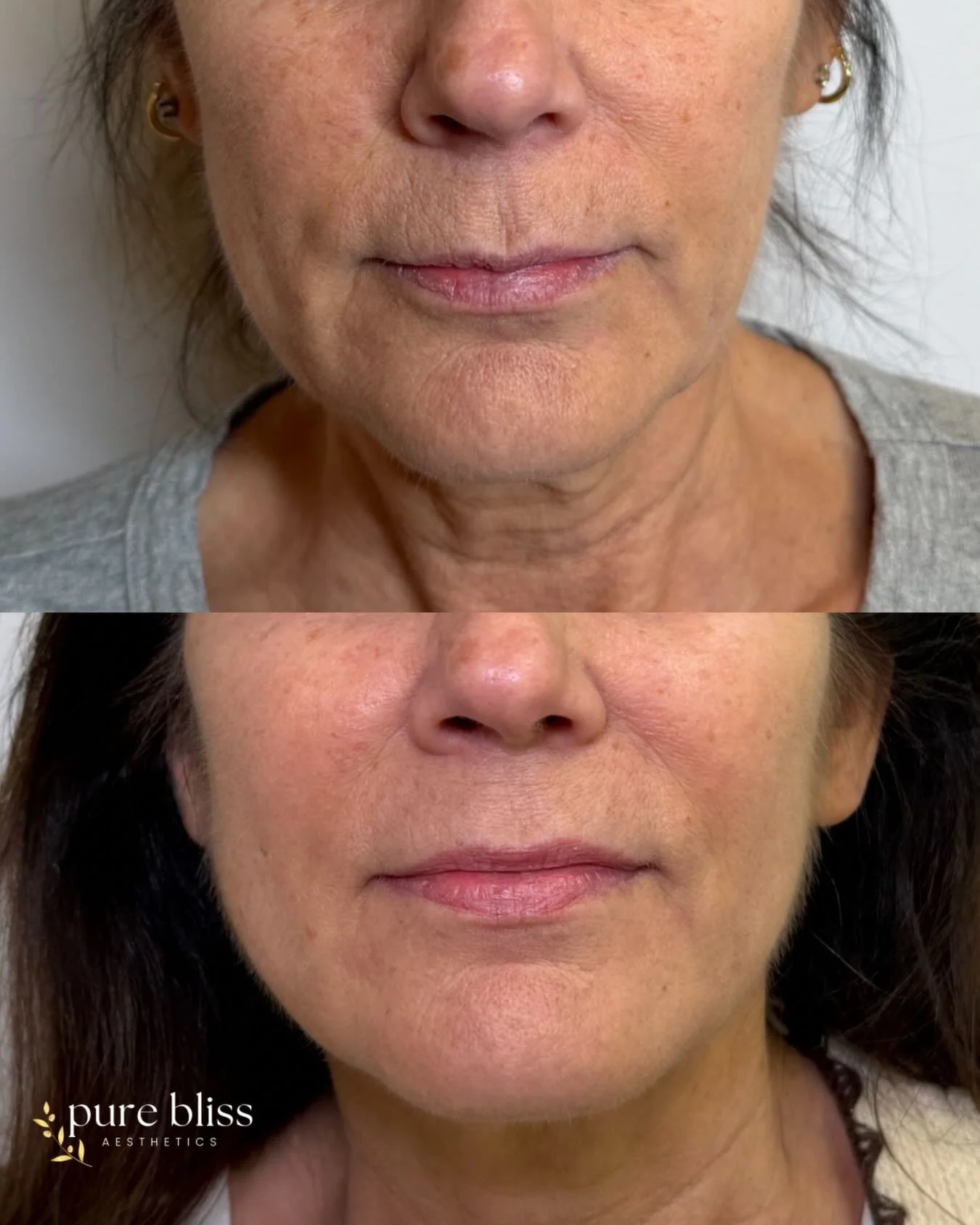 2 microneedling treatments and her skin is already transformed ✨

Noticeably softer texture, more even tone, refined pores, and the biggest transformation&hellip; her neck. The tightening and rejuvenation in this area has been incredible &mdash; smoo