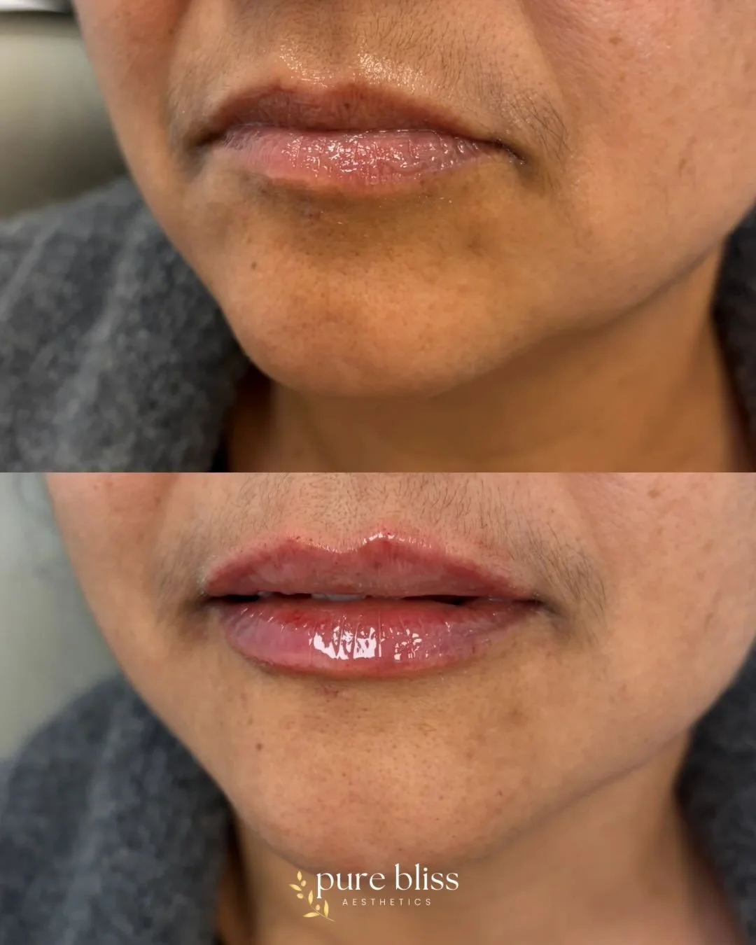 ✨ A subtle enhancement can make all the difference 💋
Balanced, hydrated, and naturally fuller lips &mdash; without losing what makes them you.

Results immediately after treatment + swelling expected.
Book your lip filler consultation at  Pure Bliss