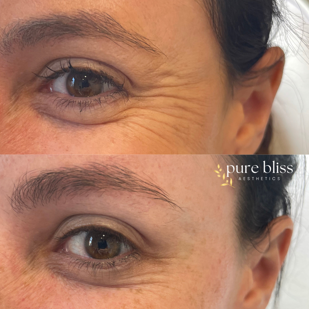 Close-up comparison of a woman's eyes showing fewer wrinkles around the eye area in the bottom image compared to the top image.