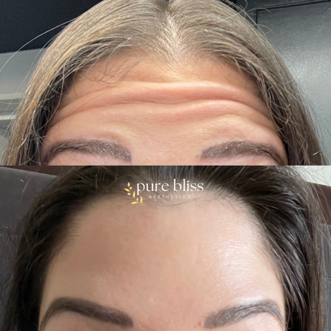 Before and after images of forehead and eyebrow enhancement, showing smoother skin and more defined eyebrows after receiving Dysport.