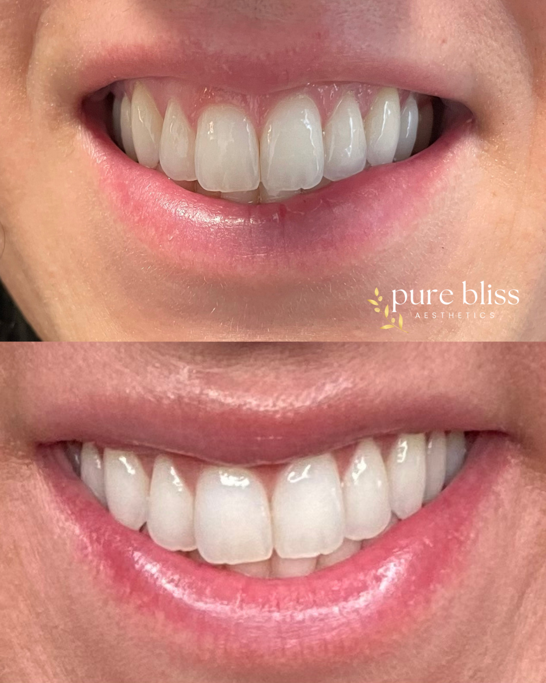 Comparison of a person's smile before and after a lip flip, showing a fuller top lip.