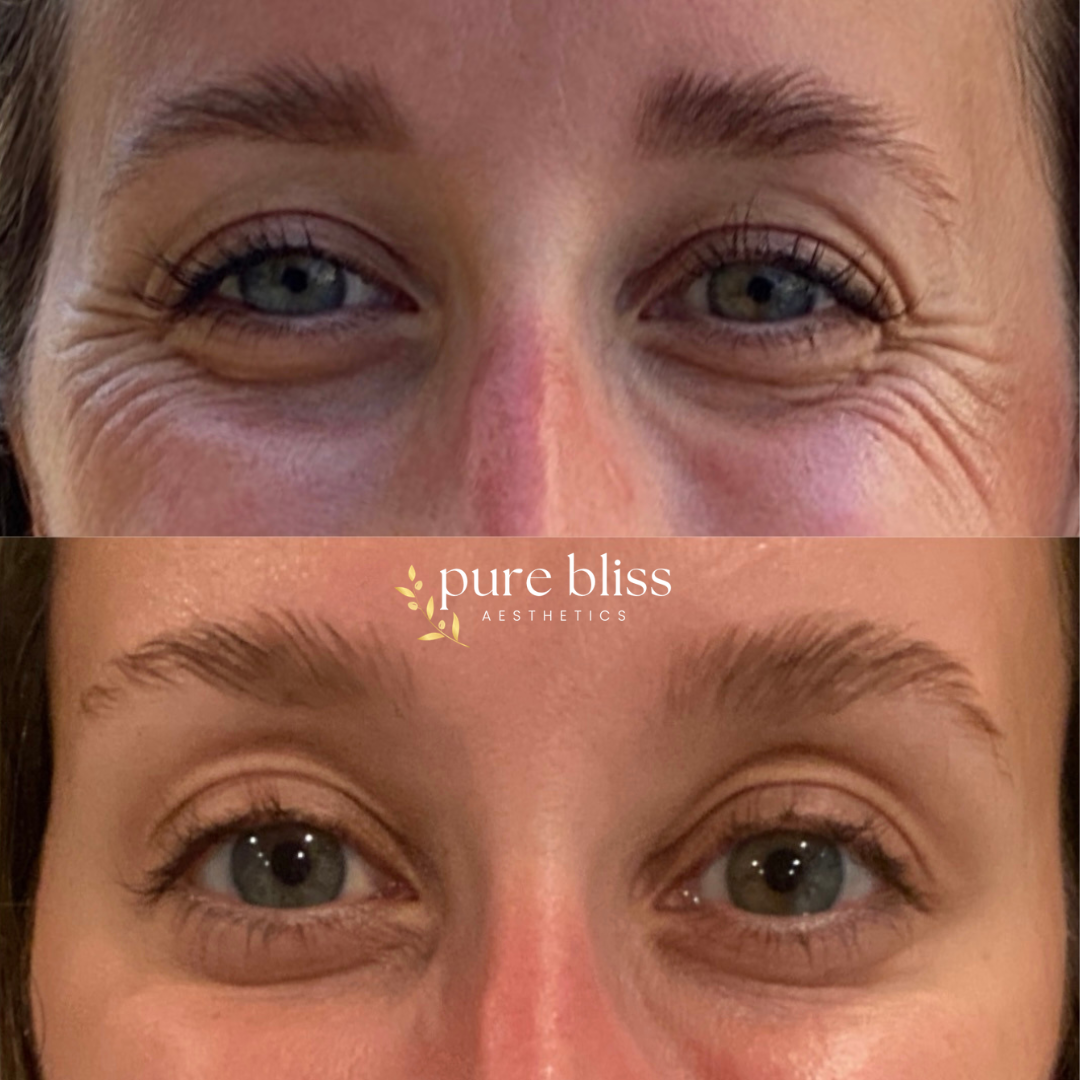 Close-up comparison of a woman's eyes showing fewer wrinkles around the eye area in the bottom image compared to the top image.