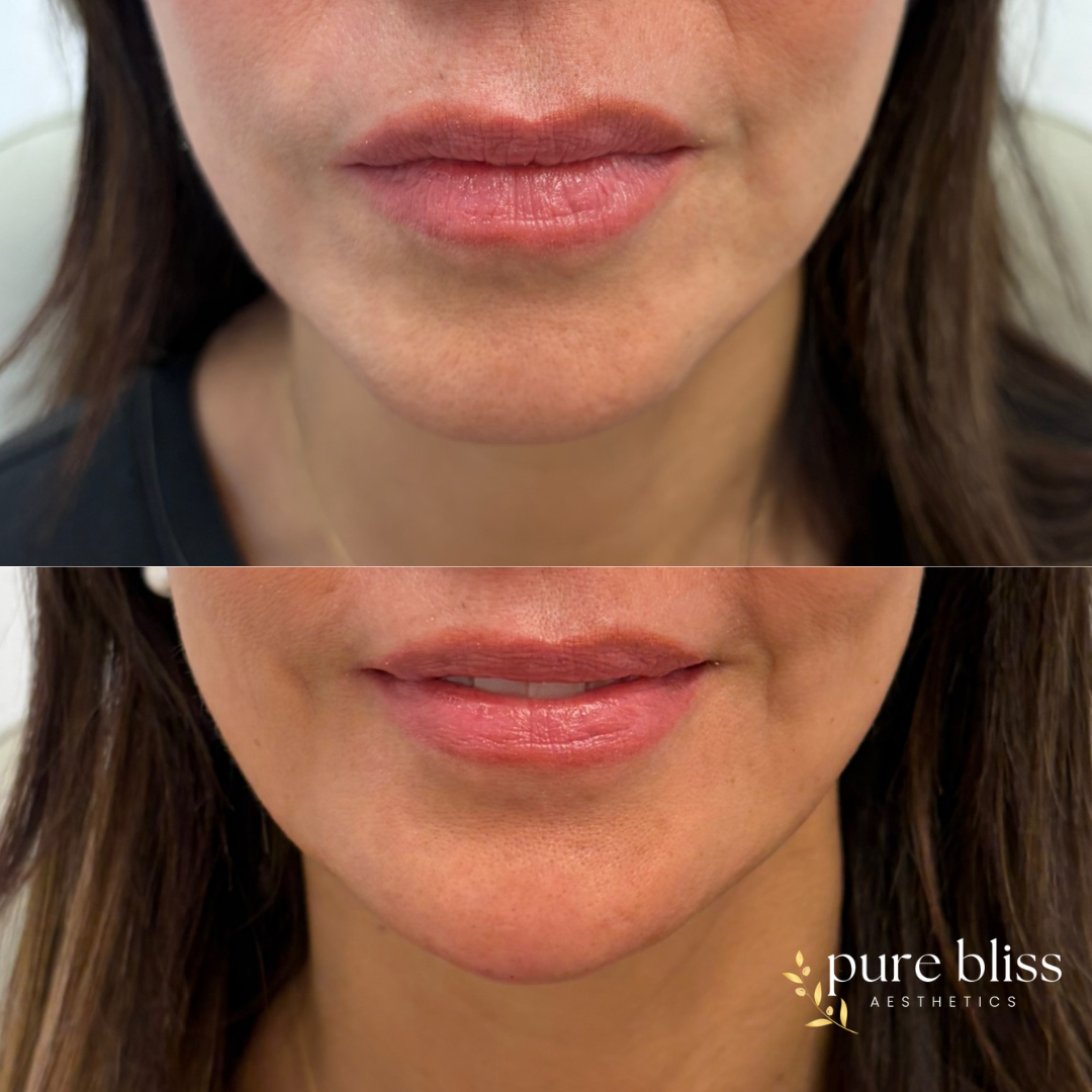 Filler before and after using 2ml of Restylane Defyne in the chin and jaw.