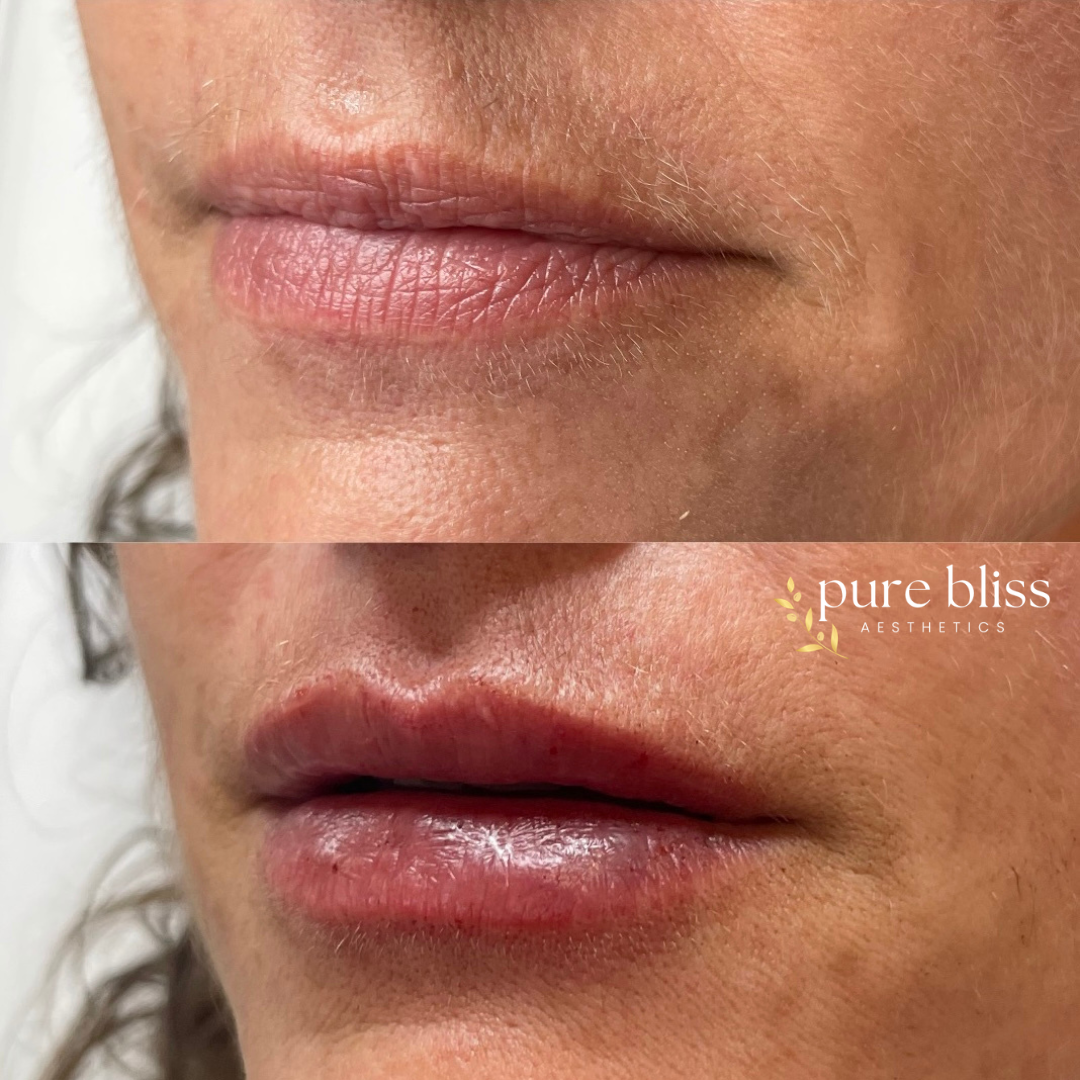 Lip filler before and after with 0.5ml of Restylane Kysse 
